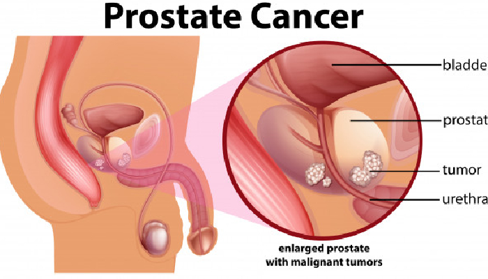 क्या होता है Prostate Cancer, जानें क्या हैं इसके लक्षण-कारण और इलाज