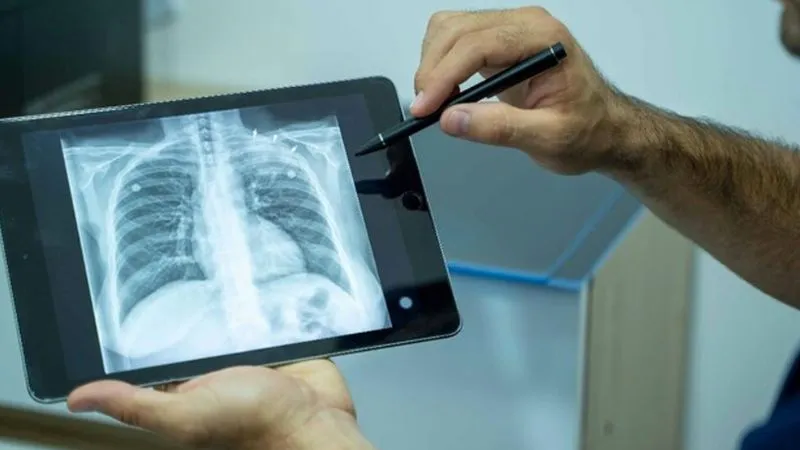 AI तकनीक से टीबी की पहचान, UP के गांवों में 100 गुना कम रेडिएशन वाली पोर्टेबल एक्सरे मशीनों से जांच शुरू