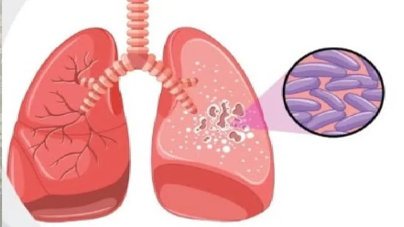 लेटेंट टीबी: निष्क्रिय लेकिन खतरनाक- समय रहते पहचान और इलाज जरूरी