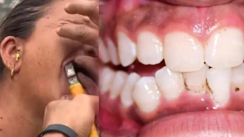 दर्दनाक हदें पार! बिना एनेस्थीसिया दांत निकालने का वीडियो वायरल, देखकर सहम जाएंगे आप