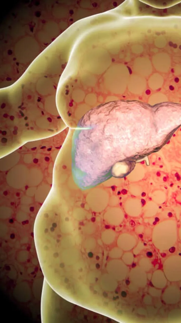 90 दिनों में फैटी लिवर रीसेट : डॉक्टर के 7 आसान तरीके, स्वस्थ लिवर पाएं!